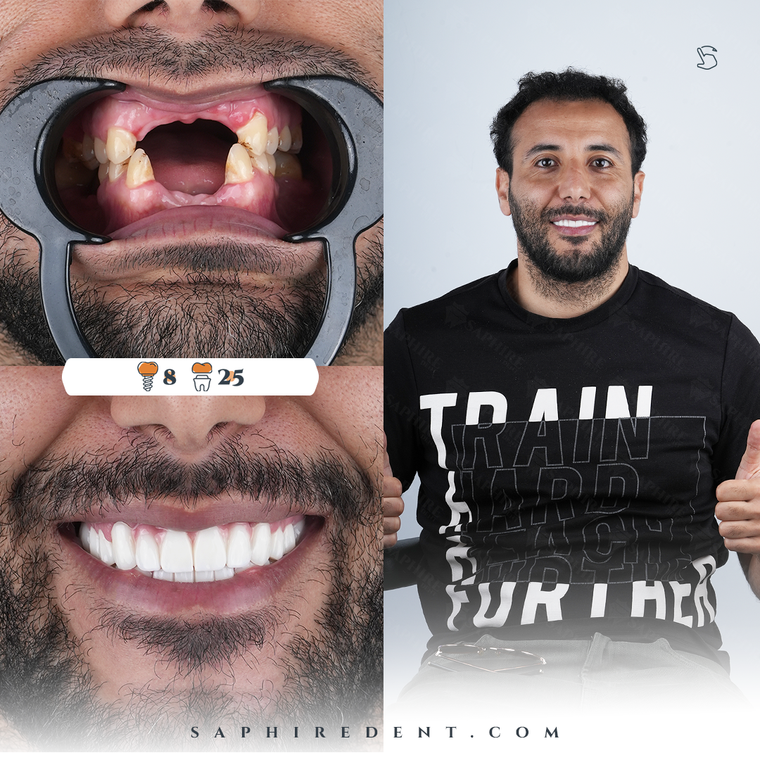 Dental Implants